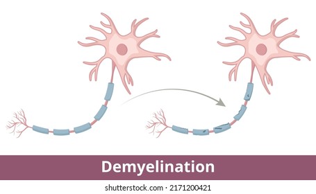 Demyelination process. Protective covering (myelin sheath) that surrounds nerve fibers is damaged due to demyelinating diseases like multiple sclerosis, optic neuritis, transverse myelitis.