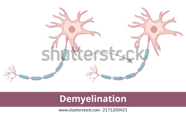 Demyelination process. Protective covering\
(myelin sheath) that surrounds nerve fibers is damaged due to\
demyelinating diseases like multiple sclerosis, optic neuritis,\
transverse\
myelitis.