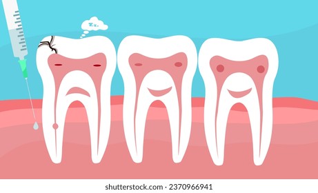 anestesia dental, escena con jeringa desechable y dientes durmientes, ilustración de material vectorial