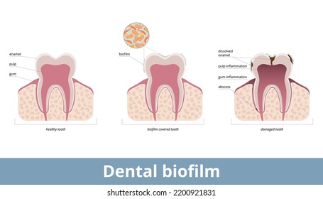 Dental biofilm. Biofilm covers teeth and causes enamel desolvation, inflammation of a gum and pulp. Biofilm on a tooth damages dental tissues, provokes abscess formation.