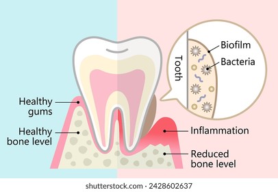 biofilm dental y diente sano. concepto de higiene dental y cuidado de la salud