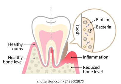 biofilm dental y diente sano. concepto de higiene dental y cuidado de la salud