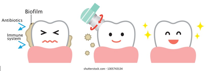 Dental Biofilm Removal Cute Cartoon Illustration. Dental Health And Oral Care Concept