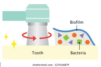 Dental Biofilm Removal Illustration. Dental Health And Oral Care Concept