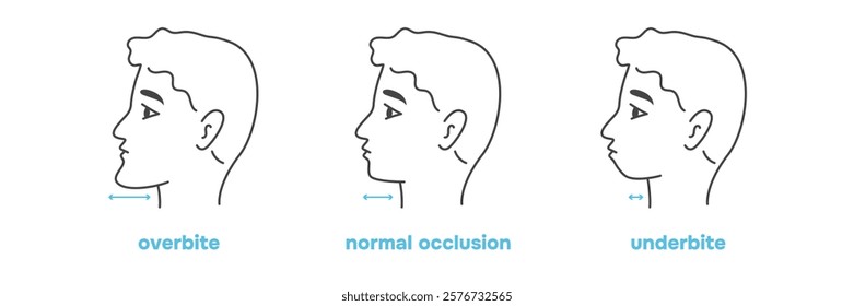 Dental bite variation. Man with malocclusion, bite correction. Vector illustration