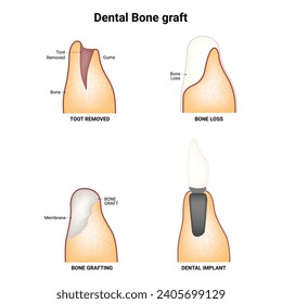 Dental Bone Graft Science Design Vector Illustration