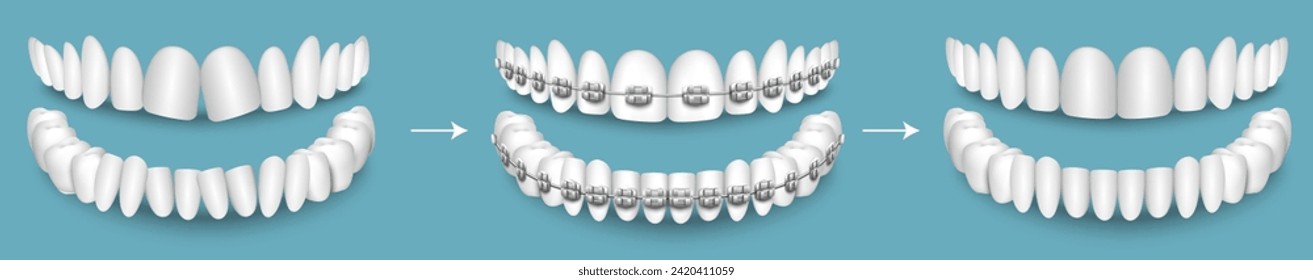 Dental braces before and after result vector illustration. Crooked and beautiful white straight teeth. Whitening and alignment treatment process