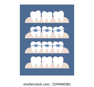 Dental braces icon. Orthodontic treatment and cosmetic odontology. Before after straightening teeth. Vector flat illustration 