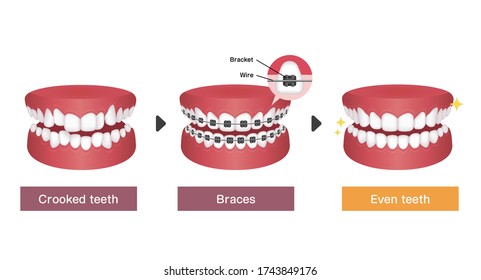 Dental braces process vector illustration 