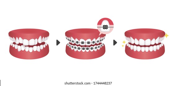 Dental braces process vector illustration / no text