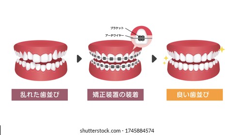 Dental braces process vector illustration. Translation: Crooked teeth, Braces, Even teeth, Bracket, Wire.