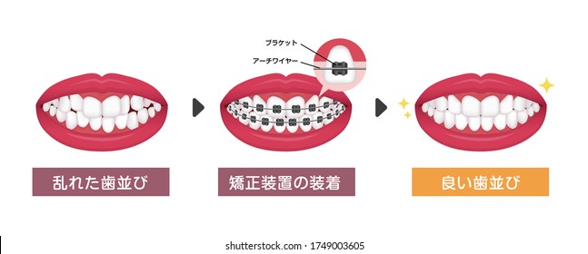 Dental braces process vector illustration. Translation: Crooked teeth, Braces, Even teeth, Bracket, Wire.