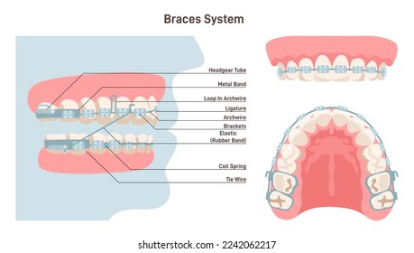 Dental braces system. Installed brackets system side, front and bottom view. Teeth care, malocclusion treatment. Orthodontics education poster. Flat vector illustration