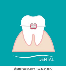 Dental Braces. Braces teeth of dental healthcare. Dental care background. Vector illustration.

