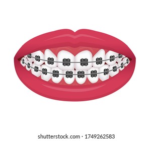 Dibujo vectorial de llaves dentales / sin texto