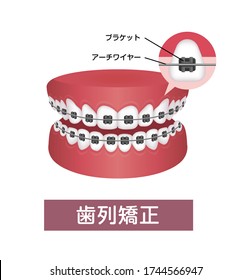 Dental braces vector illustration. Translation:  Braces, Bracket, Wire