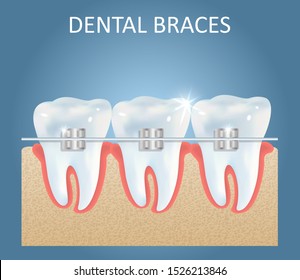 Dental braces vector medical education anatomy poster template. Realistic white teeth with brackets. Orthodontics, orthodontic treatment concept.