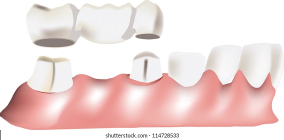 Dental Bridge