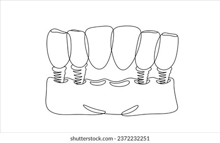 Puente dental para 6 dientes. Restauración estética de la dentición. Un dibujo de línea para diferentes usos. Ilustración vectorial.