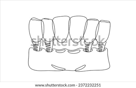 Dental bridge for 6 teeth. Aesthetic restoration of the dentition. One line drawing for different uses. Vector illustration.