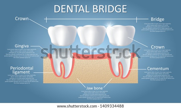 Dental\
bridge diagram. Vector educational poster, medical infographic.\
Traditional bridge consists of one artificial tooth and is held in\
place by dental crowns. Fixed dental\
restoration.
