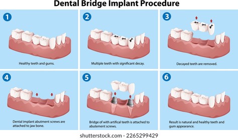 Dental bridge implant procedure illustration