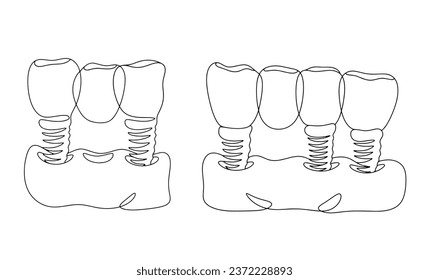 Puente dental con implantación de 3 y 4 dientes. Restauración estética de la dentición. Un dibujo de línea para diferentes usos. Ilustración vectorial.