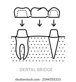 Dental bridge, line icon. Installation scheme and anatomy of artificial teeth. Dentistry and teeth restoration topic. Linear illustration, editable stroke icon