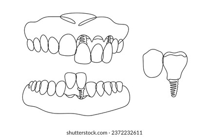 Dental bridge on the upper and lower jaw. Aesthetic restoration of the dentition. One line drawing for different uses. Vector illustration.