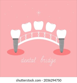 Dental bridge as a bridge over a river