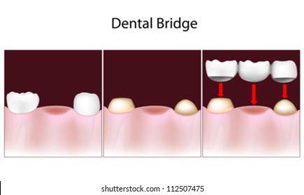 Dental bridge procedure