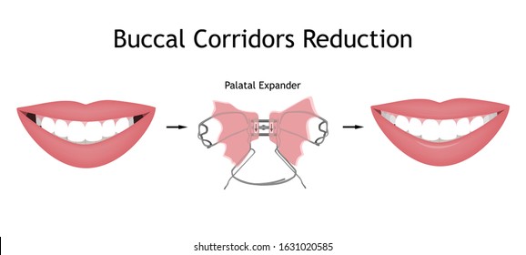 Dental buccal corridors treatment with palatal expander. The smile with large and dark buccal corridor before and after the orthotropics or orthotropics correction. Vector illustration.