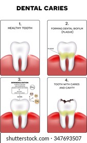 Dental caries formation, dental plaque, loss of calcium, phosphate and finally caries and cavity