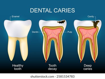 Dental caries. Healthy tooth, Tooth decay and Deep caries. Cross section of a human tooth with layer of enamel at the crown, Cavity, Pulp, and Dentin. Diagram of molar anatomy. Vector poster