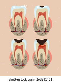 Dental Caries Stages