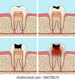 Dental caries stages. Cross section tooth anatomy and damage.  Vector illustration