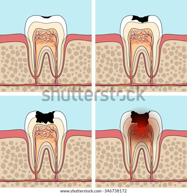 Dental Caries Stages Cross Section Tooth Stock Vector Royalty Free