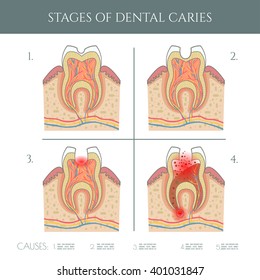 Dental caries stages.Dental infographic.. All objects are conveniently grouped  and are easily editable.