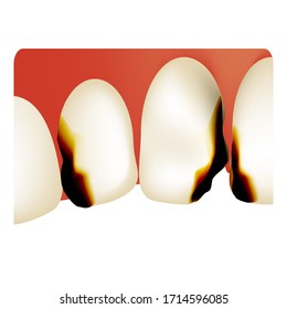 Dental caries. tooth decay. Caries infographics. Vector illustration on isolated background.