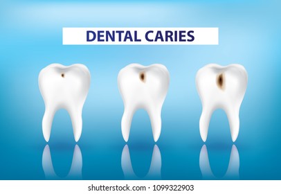 Dental caries vector illustration
