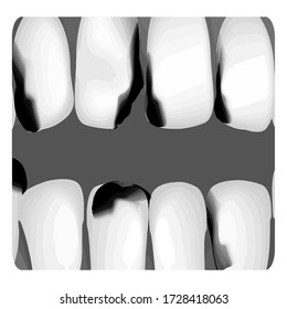 Dental caries. X-ray of tooth decay. Caries infographics. Vector illustration on isolated background.
