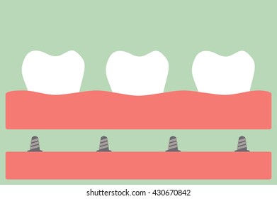 dental cartoon vector, cosmetic implant