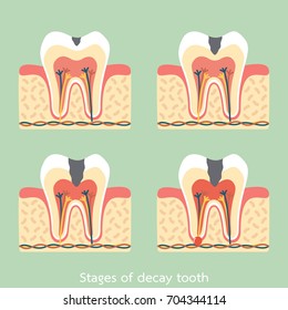 dental cartoon vector flat style for design, stages of decay tooth anatomy structure including the bone and gum