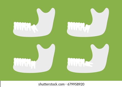 dental cartoon vector, set of type of wisdom tooth with mandible or lower jaw isolated on green background. flat style