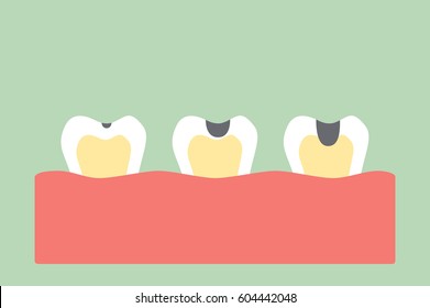 dental cartoon vector, stages of tooth decay
