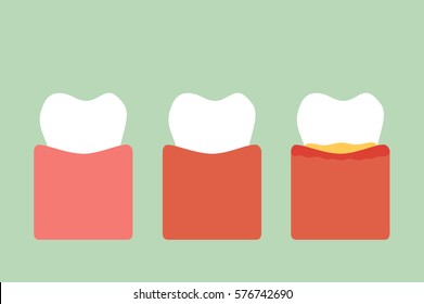 dental cartoon vector, step of gum disease - healthy teeth, gingivitis and periodontitis