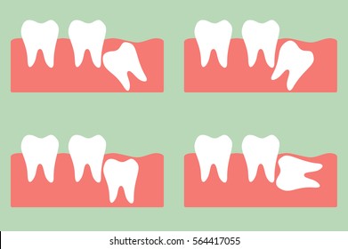 dental cartoon vector, type of wisdom tooth