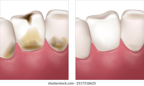 Cáries dentárias, cáries dentárias, cáries. Cárie dentária e dentes normais. Destruição de um dente por cárie dentária e doença 