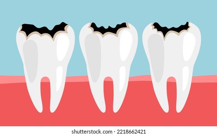 Dental cavity concept vector illustration. Dental problem. Toothache. Oral care.