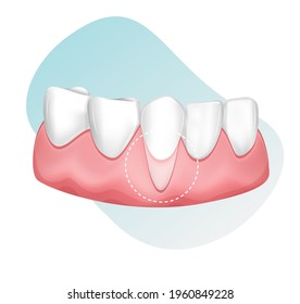 Dental Checkup for Receding Gums - stock illustration as EPS 10 File